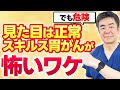 【早期発見必須】見逃されやすいスキルス胃がんがなぜ怖いのかを徹底解説