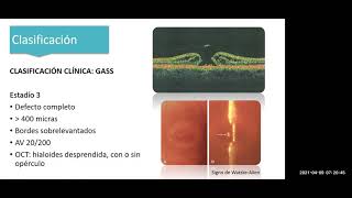 Agujero Macular. Dra Laura Martinez . 2021-4-9