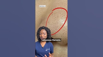 Black Dots on the Nose? Sebaceous Filaments & How To Get Rid Of Them + Products