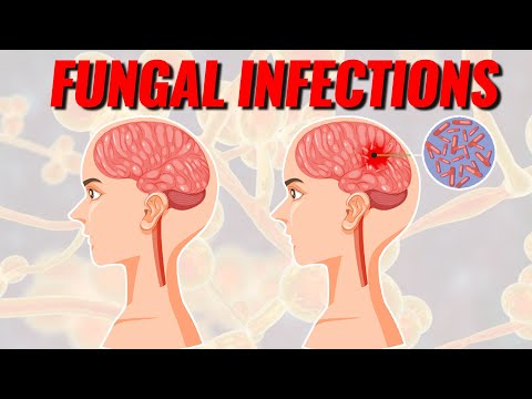 Video: Throat mycosis