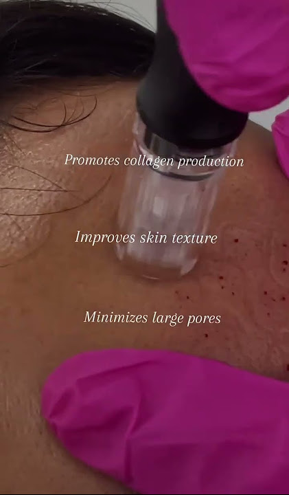 ✨Microneedling - Unluck Your Skins Potential ✨