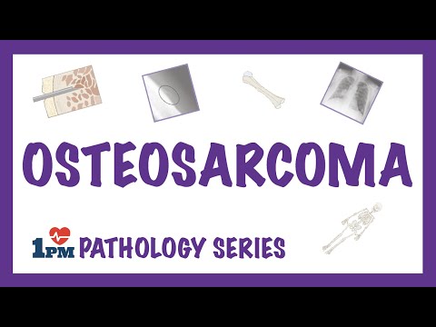 Osteosarcoma - Pathology, Symptoms, Diagnosis, Treatment
