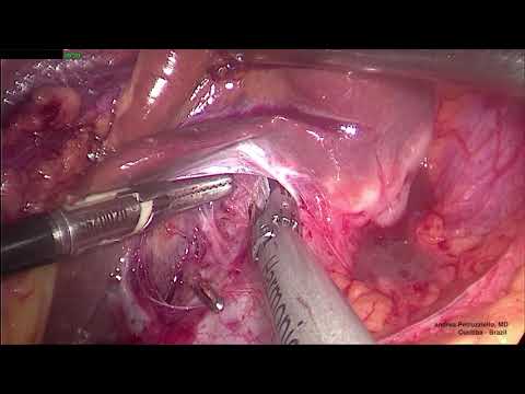 Video: Anatomija, Dijagram I Funkcija Caudate Režnja - Karte Tijela