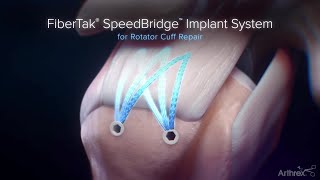 FiberTak® SpeedBridge™ Implant System Features and Benefits