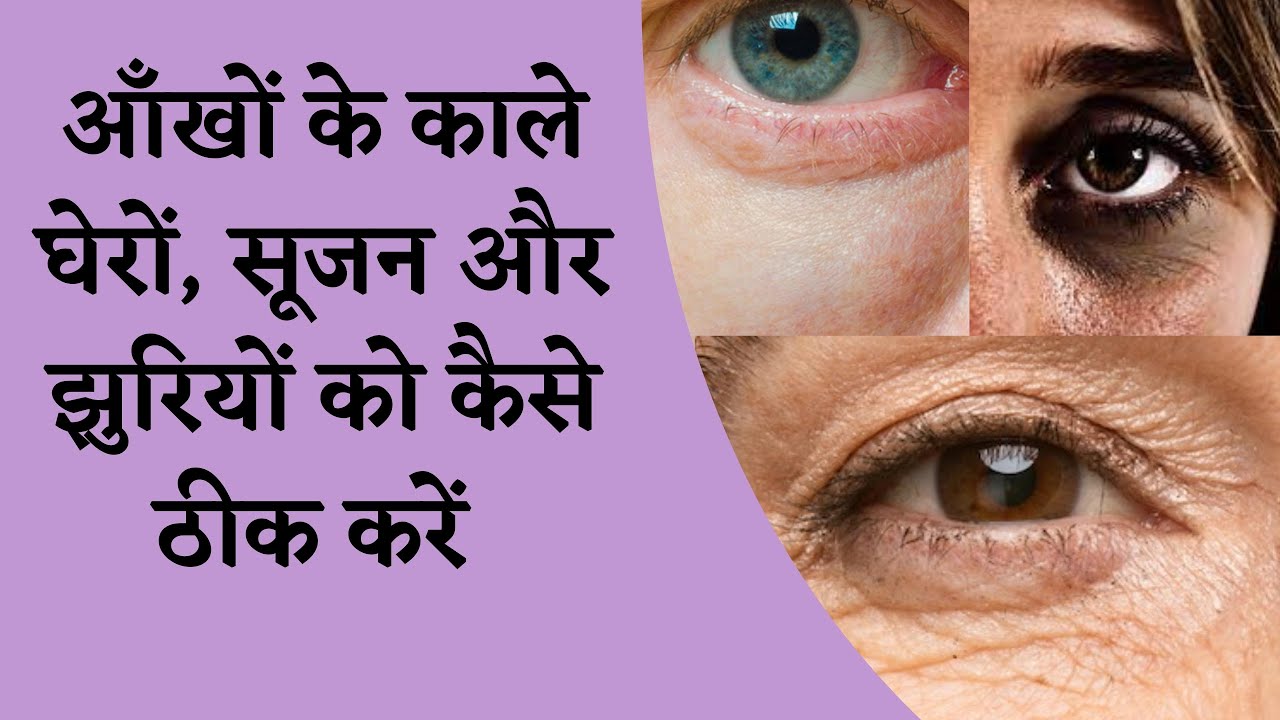 आँखों के काले घेरे जड़ से ख़त्म करें, Remove Dark Circles Permanently I DR. MANOJ DAS