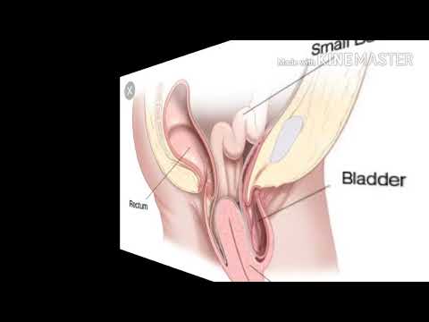 Video: Yuav Ua Li Cas Cev Xeeb Tub Nrog Polycystic Ovary Syndrome (PCOS)