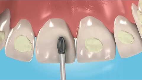 Frank Dental Orthodontic Debonding Burs - Adhesive Remover Bur - 379AGK