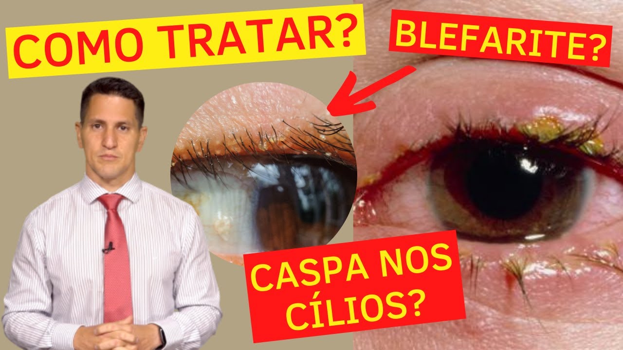 Tratamento de Blefarite ou Terçol em Curitiba