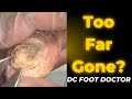 Too far gone severe fungal toenails