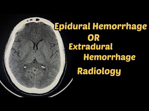 EDH Epidural Hemorrhage or Extradural Hemorrhage | Brain 🧠 bleed 🩸| Diagnosis | CT Scan| Radiology