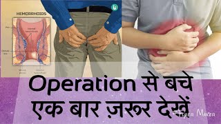 Operation से सावधान,बवासिर(piles),पेटदर्द(stomache pain),क़ब्ज़(constipationपेट के सभी रोगों का इलाज