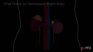 Adrenal Surgery. Carling Adrenal Center  Animation of the PARTIAL Adrenalectomy (Adrenal Surgery)