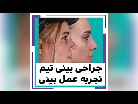 نمونه تغییرات بینی استخوانی با عمل بینی