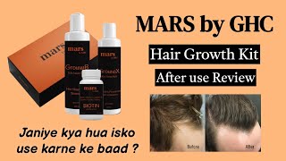 Mars by Ghc Hair Growth Kit After use Review | Total hair loss solution - Arogya Gyan
