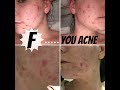 MY ACNE JOURNEY | MENTAL HEALTH AND BULLYING |