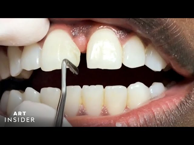 Teeth Bonding For Gaps, Teeth Gap Filling Cost