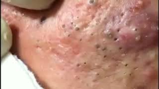 Best Blackhead Removal Ever 2020