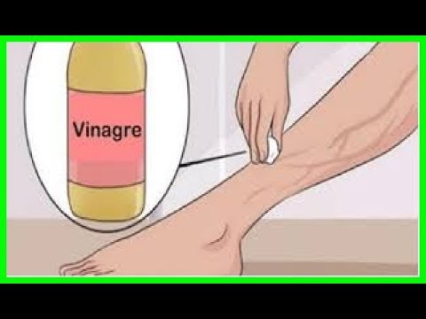 No Sigas Gastando Dinero Mezcla Estos 3 Ingredientes Para Quitar Tus Varices Para Siempre