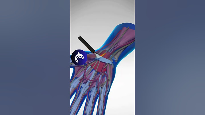 Carpel Tunnel Surgery - See How It is Fixed #carpaltunnelsyndrome #chronicpain