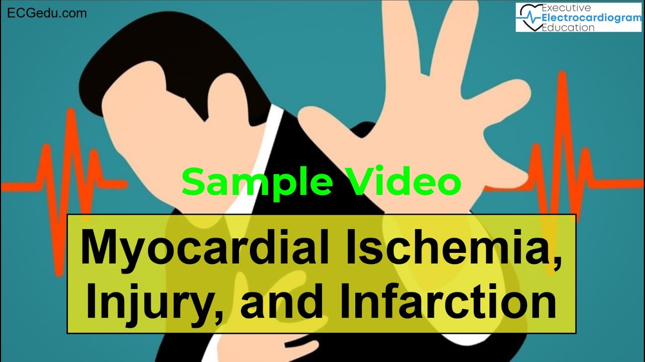 Myocardial Ischemia and Infarction on ECGs - YouTube