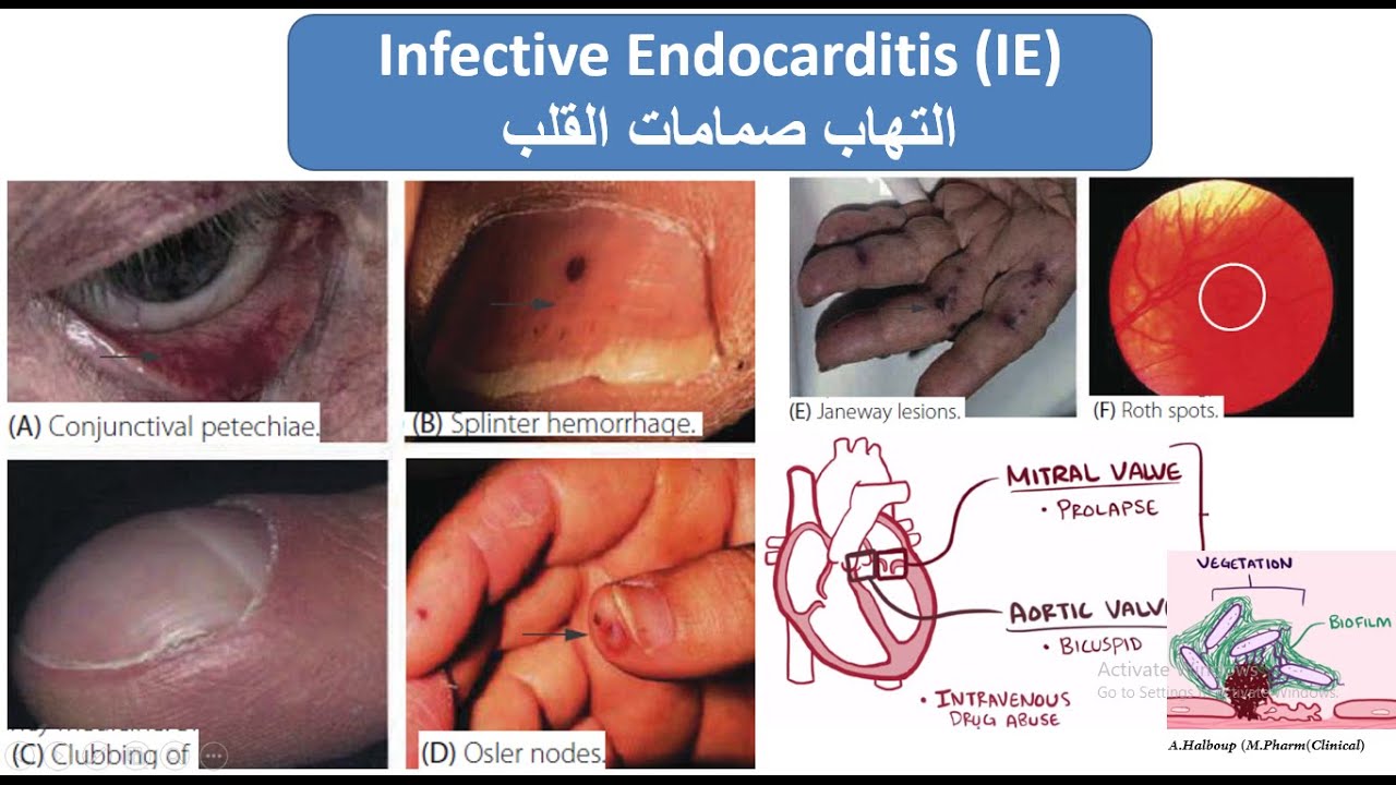 Infective Endocarditis (إلتهاب صمامات القلب )