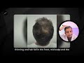 PRP Hair Loss Treatment Before and After Success Stories
