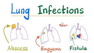 Lung Infection; Lung Abscess, Aspiration Syndromes, Systemic fungi