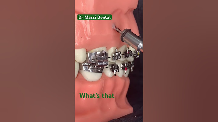 Dental Braces, Orthodontics,teeth alignment