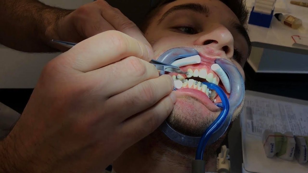 Postavka Fiksne Proteze Review - Vlog