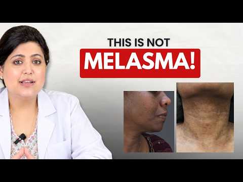 LPP (Lichen Planus Pigmentosus): Causes & Treatment Options