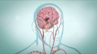 What Really Happens During an Ischemic Stroke? 🧠 (Animated Explanation)