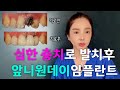 심한충치 앞니임플란트 #발치식립보철당일완성 #앞니원데이임플란트