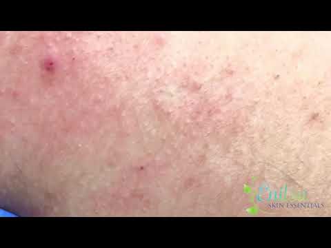 Black Head Extraction on Christians Back