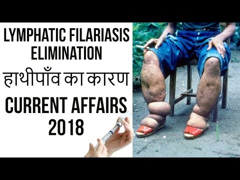 Video: Beban Hydrocoele Dinilai Dari Catatan Medis Dan Bedah Di Negara Endemik Filariasis Limfatik, Samoa