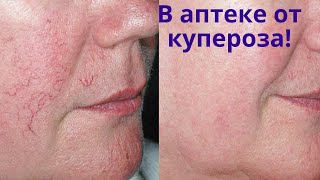 От купероза и сосудистой сеточки! Домашняя косметика от купероза своими руками!