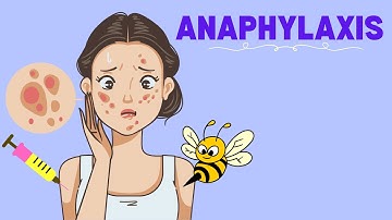 Anaphylaxis: Definition, Pathophysiology, Treatment (Anaphylaxis 101)