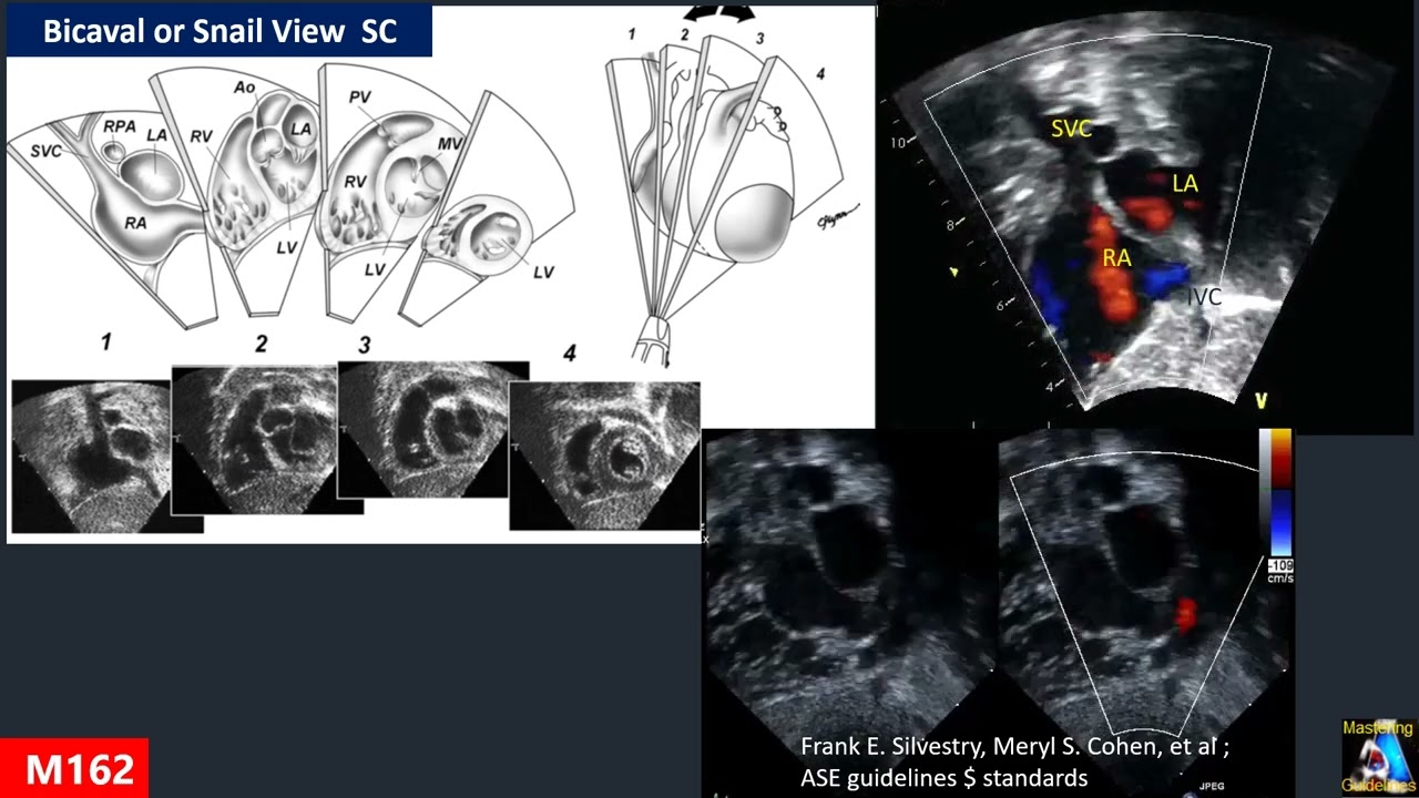 Atrial Septal Defect ( ASD & PFO )