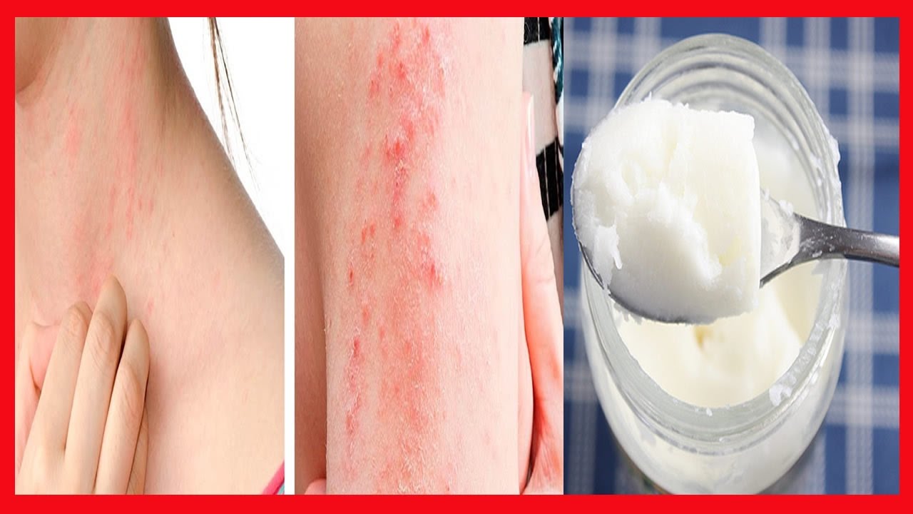 Saiba Como EVITAR Alergias na Pele Por Causa do Calor - Creme Caseiro ...