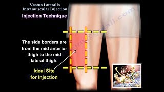 Vastus Lateralis Intramuscular Injection - Everything You Need To Know - Dr. Nabil Ebraheim
