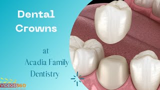 Dental crowns at Acadia Family Dentistry