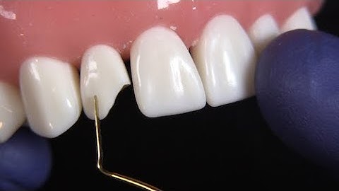 Tips on Beveling when using the NEW Fusion Anterior Matrix System with Dr. JD Corey