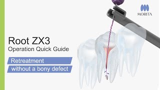 Root ZX3 Operation Quick Guide - Retreatment -without a bony defect