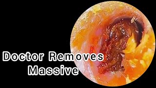 Doctor Removes Mive Ear Blockage Wow