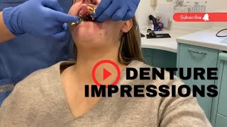 DENTURE IMPRESSIONS | PART TWO