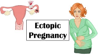 Ectopic Pregnancy - Causes, Risk  Factors, Signs & Symptoms, And Treatment
