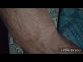 Remedy to remove Elegery in an hour