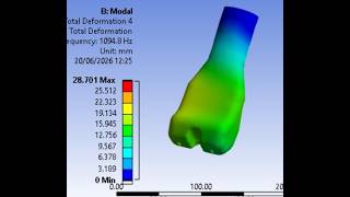 CAD &amp; Finite Element Analysis of Femur Thigh Bone Injury in Sports Biomechanics, Kinesiology, Gait