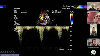 Left Ventricular Dynamic Obstruction