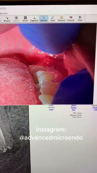 #dentists #dentalartistry #dentalcare #hygienist #dentist #apexdental #dentalprocedure #rootcanal