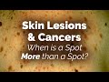 Skin Lesions and Cancers: When is a Spot More than a Spot?